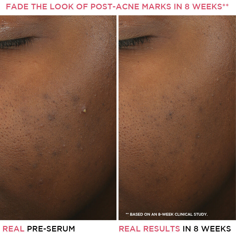 Bye Bye Breakout Salicylic Acid Acne Serum